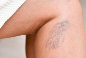 Reticular Veins