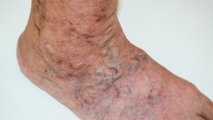 What Are Varicose Veins?