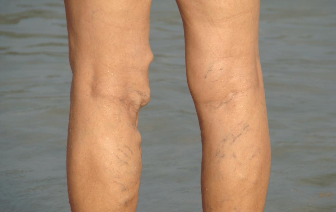 When to Worry About Varicose Veins