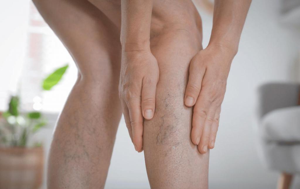 Do I Have Spider Veins or Stretch Marks?