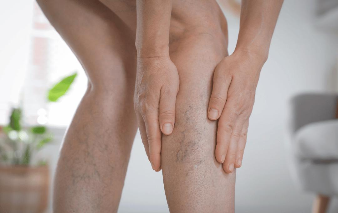 Do I Have Spider Veins or Stretch Marks?