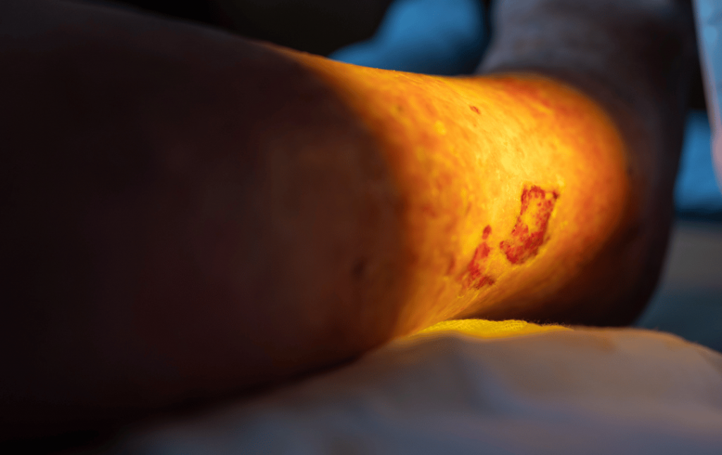 Do Leg Ulcers Lead to Amputation?