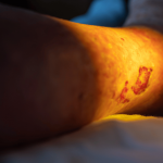 Do Leg Ulcers Lead to Amputation?