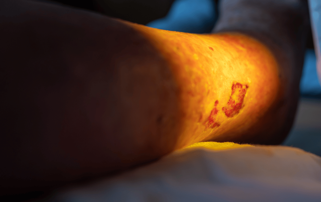 Do Leg Ulcers Lead to Amputation?