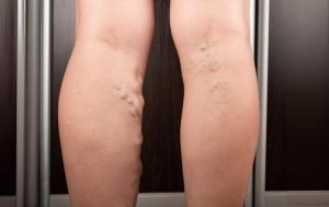 What Is The Small Saphenous Vein? 7 Close-up of varicose veins on legs.