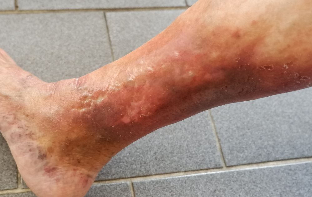Untreated Varicose Veins