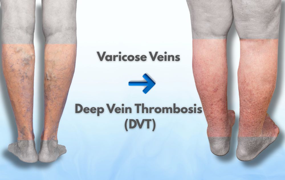 Can Varicose Veins Turn Into DVT?
