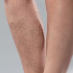 Why Do Varicose Veins Sometimes Occur In Only One Leg? 9 Photo of Varicose Veins in One Leg