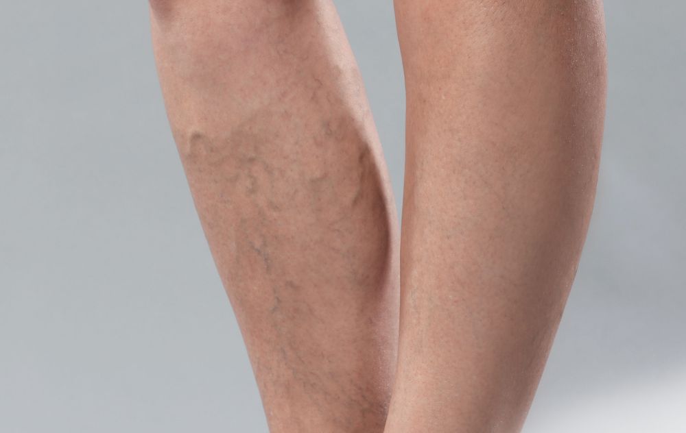 Photo of Varicose Veins in One Leg