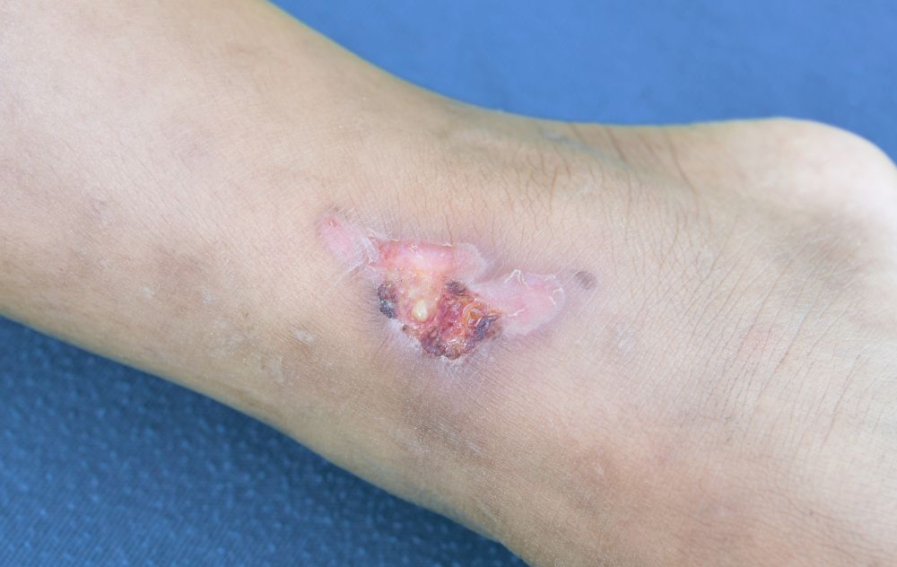 Venous Stasis Ulcer Stages