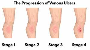 Venous Ulcer Stages