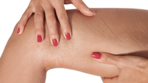 What Causes Stretch Marks on the Legs?