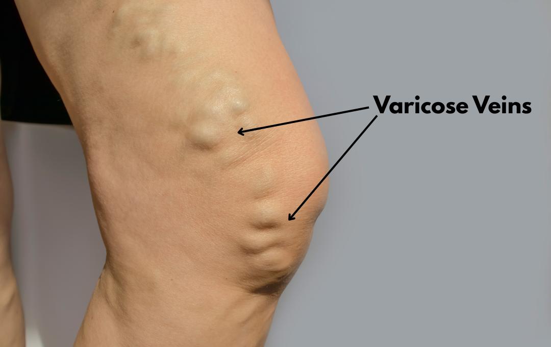 What Do Varicose Veins Mean