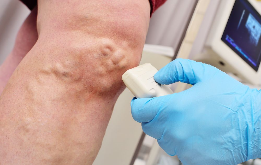 Seeing How to Diagnose Varicose Veins