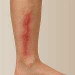 Are Varicose Veins a Symptom of Phlebitis?