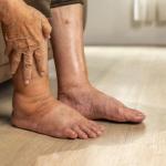 Understanding Trump's chronic venous insufficiency diagnosis