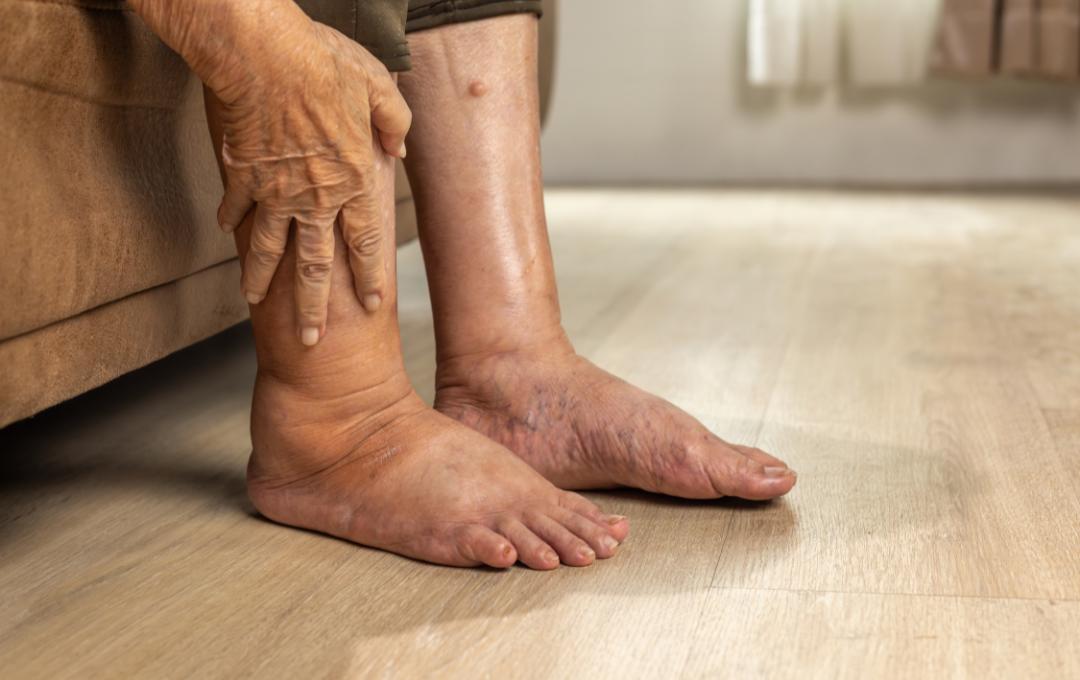 Understanding Trump's chronic venous insufficiency diagnosis