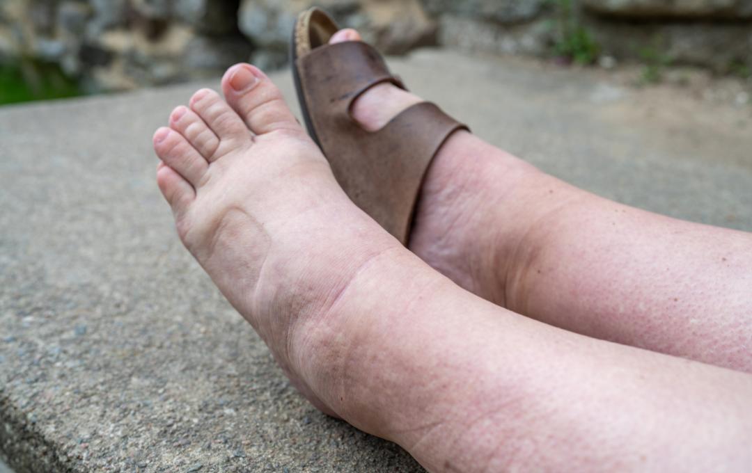 leg swelling is a common symptom of chronic venous insufficiency