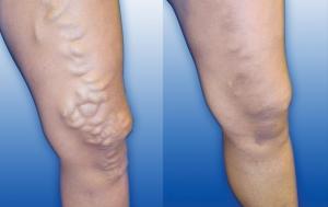 legs that need treatment for venous insufficiency