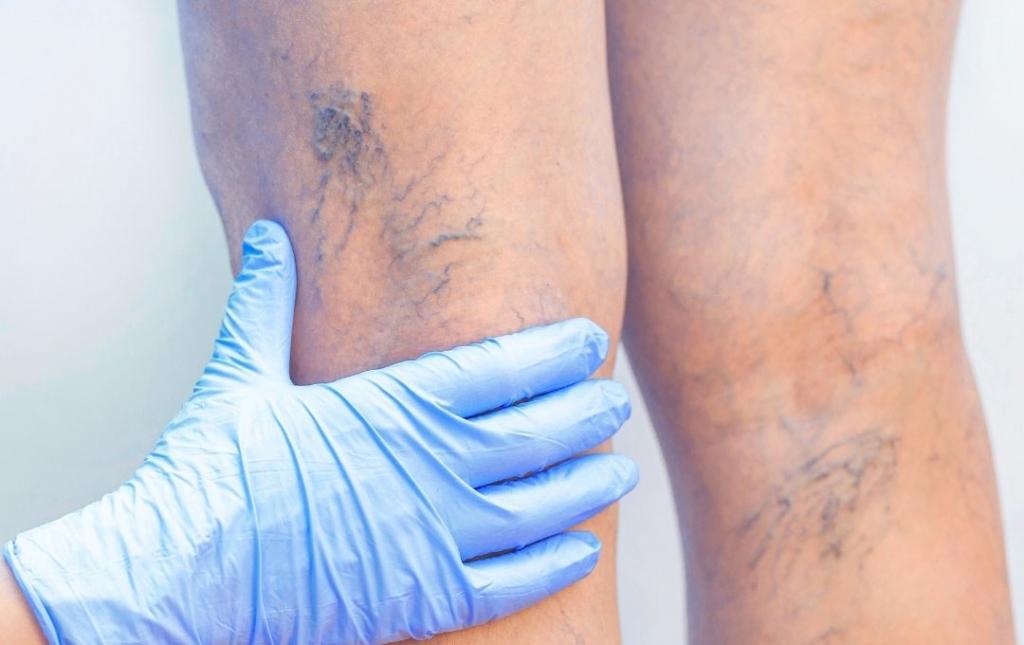 Looking at how to remove small varicose veins