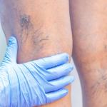 How To Remove Small Varicose Veins 11 Looking at how to remove small varicose veins