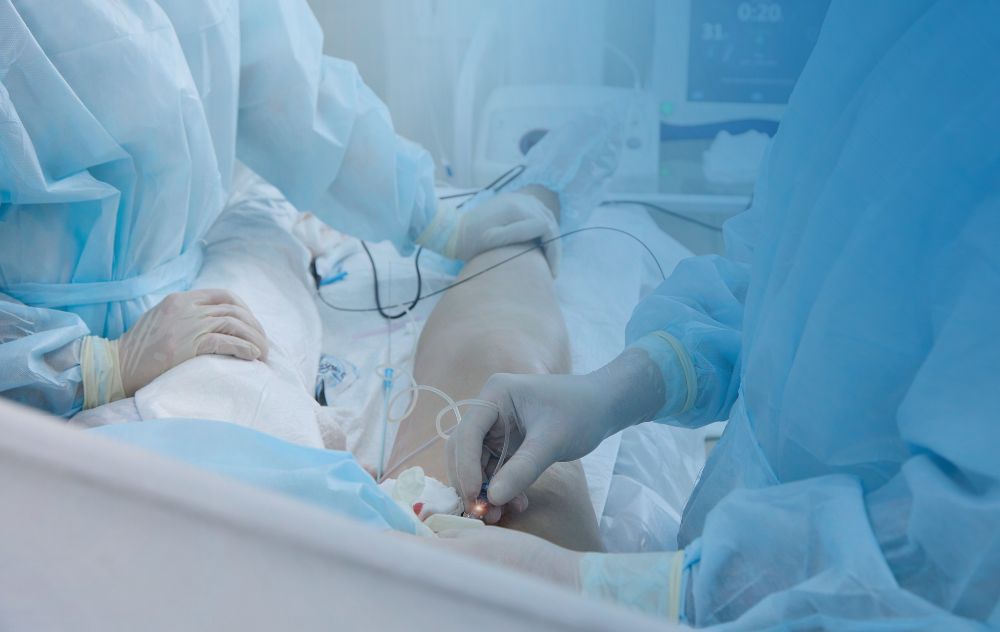 radiofrequency ablation (rfa) varicose veins
