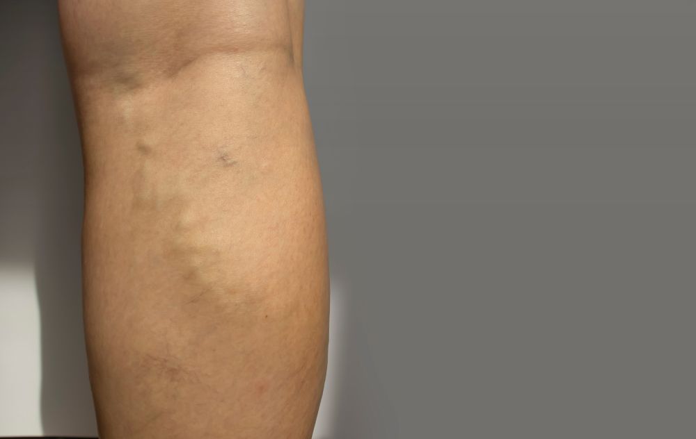 Is A Swollen Vein A Blood Clot? 4 Swollen Veins and Blood Clots