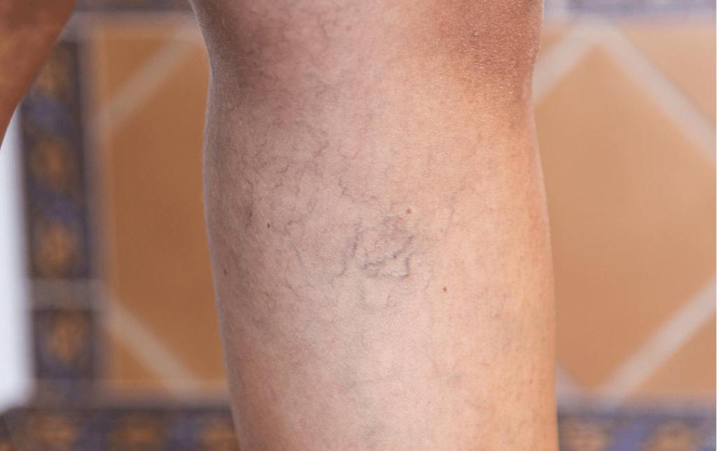 What Causes Spider Veins?