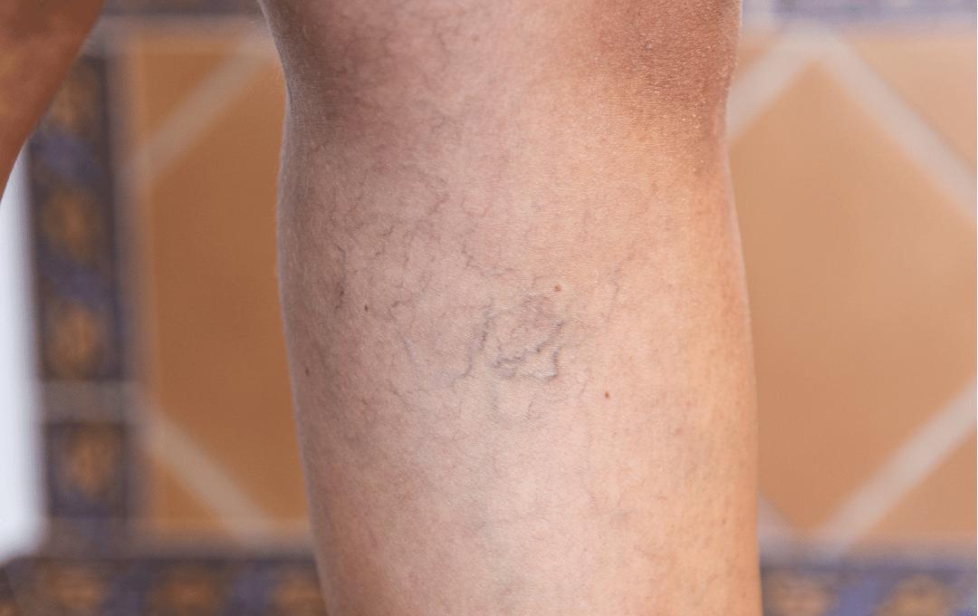 What Causes Spider Veins? 4 What Causes Spider Veins?