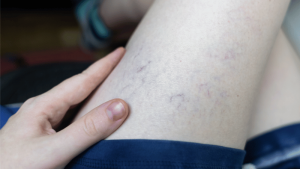 When Are Spider Veins More Than Cosmetic?