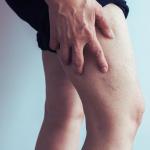 Are Spider Veins Dangerous? 7 potentially dangerous spider veins on a person's leg