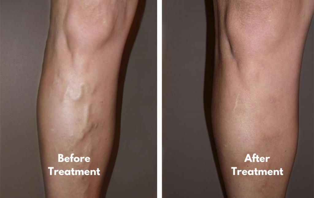 Comparison or varicose veins before and after treatment.