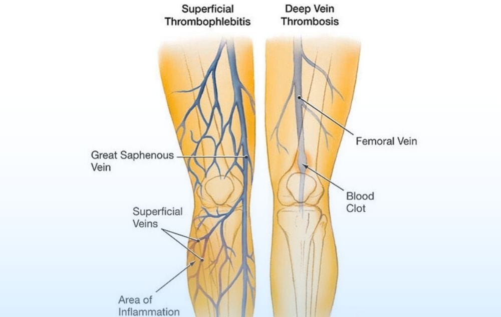 Superficial Thrombophlebitis 4 Superficial Thrombophlebitis