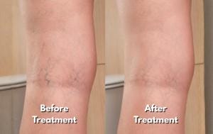 Before And After 11 Pictures of a person's legs before and after they remove their spider veins.