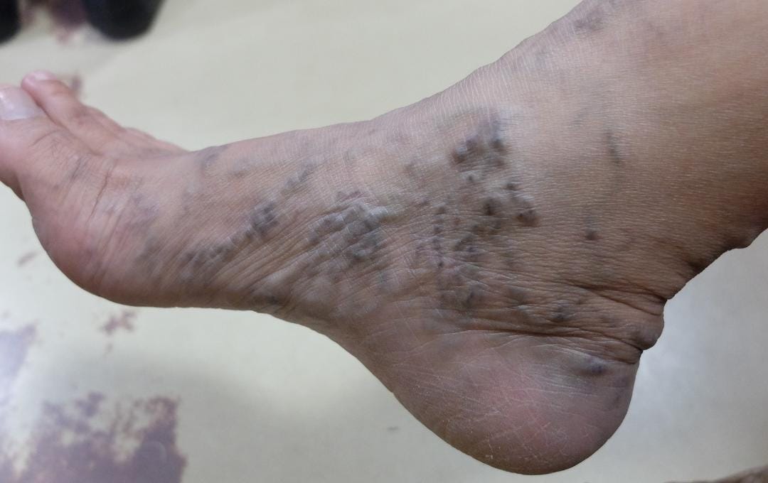 How To Tell If You Have Blood Clots In The Feet 6 A foot with varicose veins, a risk factor for blood clots.