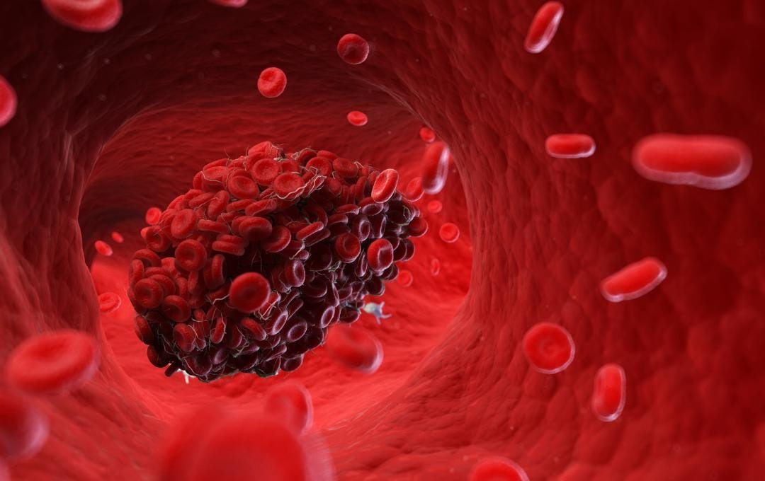 How To Tell If You Have Blood Clots In The Feet 5 Blood clot in a vein.