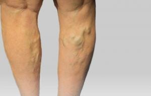 What Does An Unhealthy Vein Look Like? 8 Can varicose veins show up overnight?