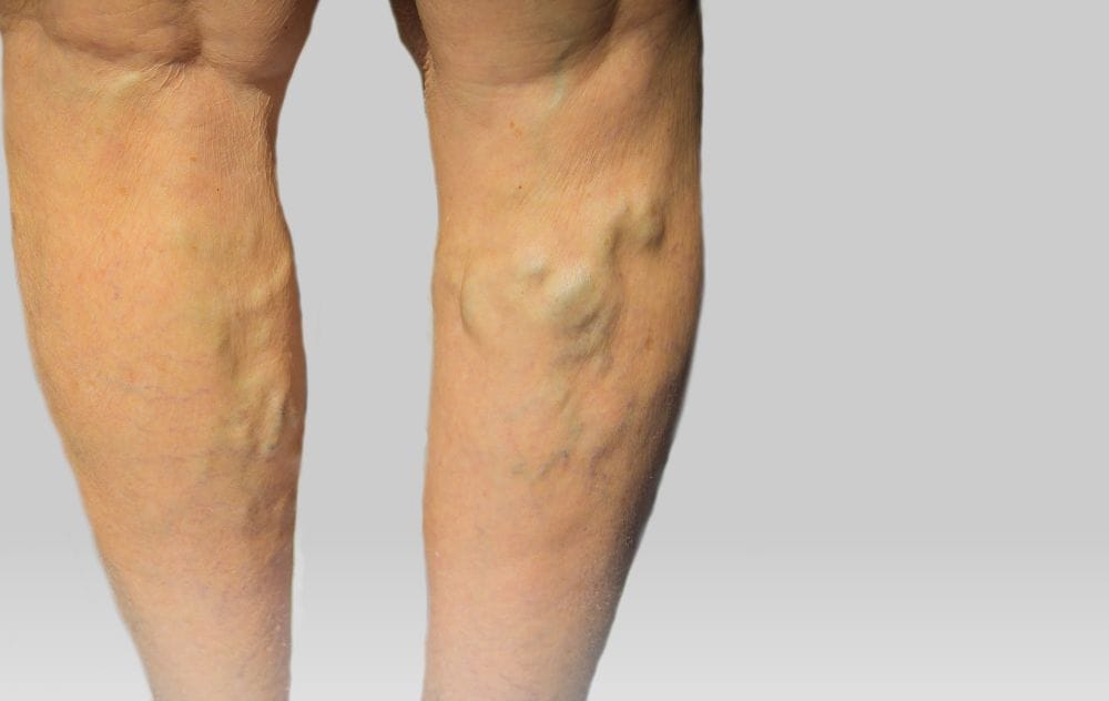 Can Varicose Veins Appear Overnight? 5 Can varicose veins show up overnight?