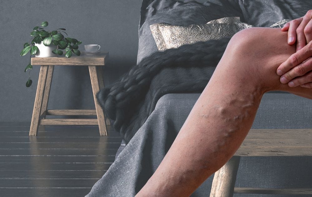 Can Varicose Veins Appear Overnight? 4 Can Varicose Veins Appear Overnight?