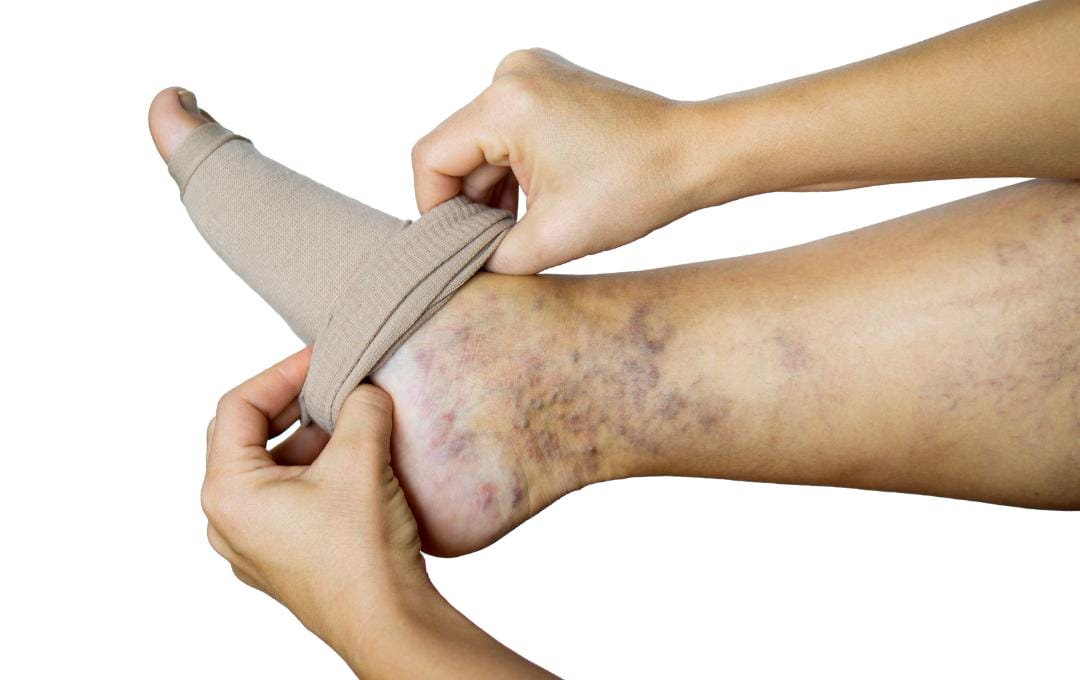 Stasis Dermatitis: How Vein Issues Cause Skin Changes 6 Patient puts on compression stockings to help manage vein disease and stasis dermatitis.