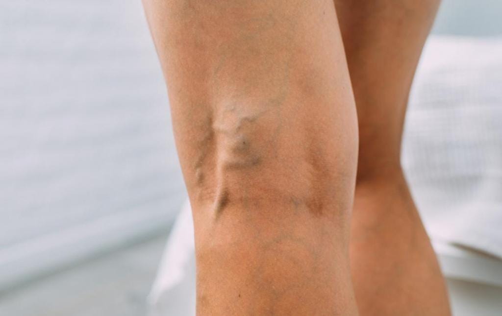 How Do I Know My Varicose Veins Need Treatment? 18 Varicose veins behind the knee.