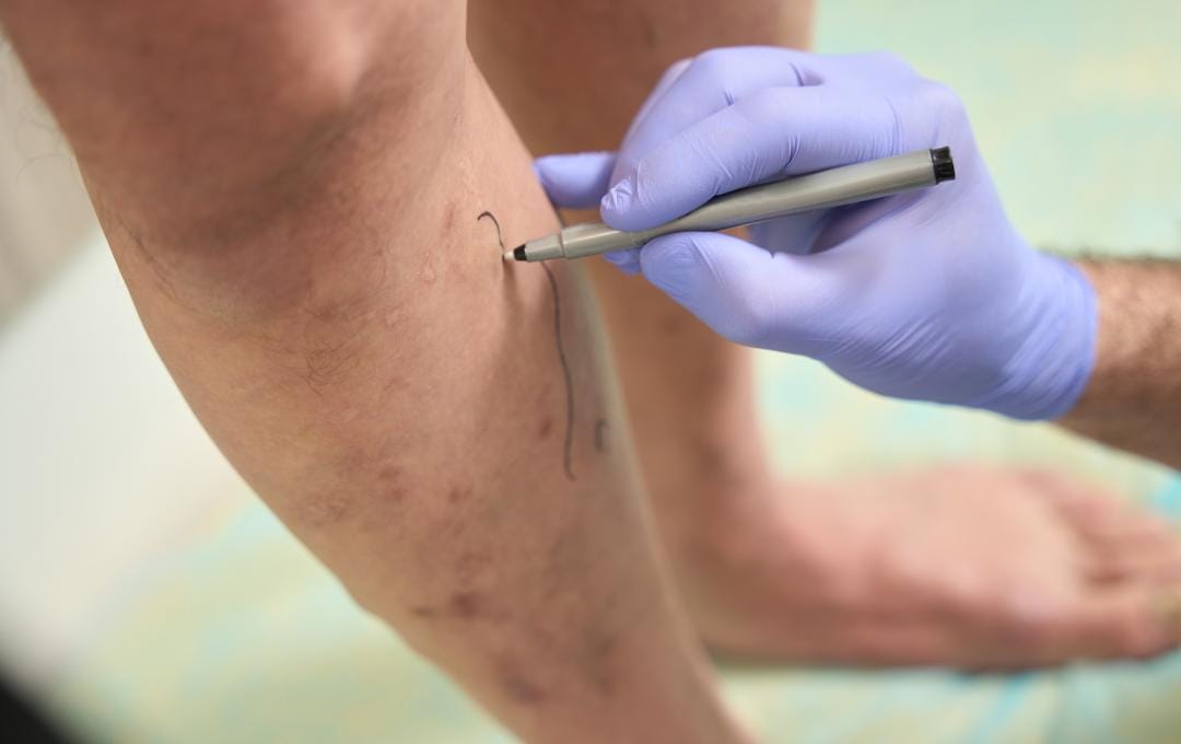 Stasis Dermatitis: How Vein Issues Cause Skin Changes 7 A vein specialist draws on a patient's legs to identify where the doctor will treat the veins.