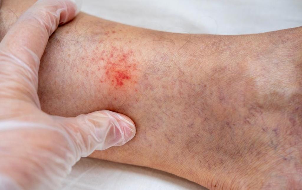Stasis Dermatitis: How Vein Issues Cause Skin Changes 21 stasis dermatitis