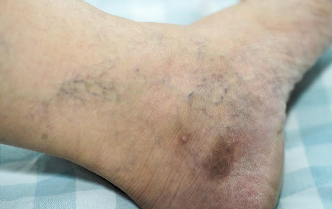 Stasis Dermatitis: How Vein Issues Cause Skin Changes 5 Ankle with visible veins from CVI and stasis dermatitis near the heel.