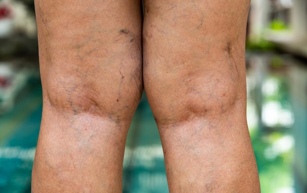 Should You Be Worried About Chronic Venous Insufficiency? Know Your Risk 6 Varicose veins on the back of a patient's legs, which are an early sign of chronic venous insufficiency.