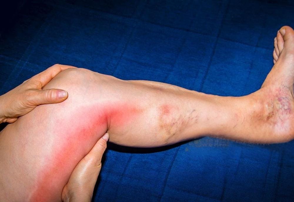 What Is Phlebitis? Causes, Symptoms &Amp; Treatment 5 An red leg with discolored bulging veins showing what phlebitis looks like in the legs.