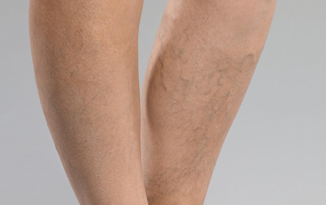 Understanding Brown Skin Discoloration On The Lower Legs 6 Varicose veins on a patient's legs, which can appear alongside lower leg discoloration.