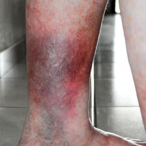 Other Types Of Venous Disease 4 Leg showing an itchy, red rash or red dots on the shins or legs may be symptoms of venous stasis dermatiti