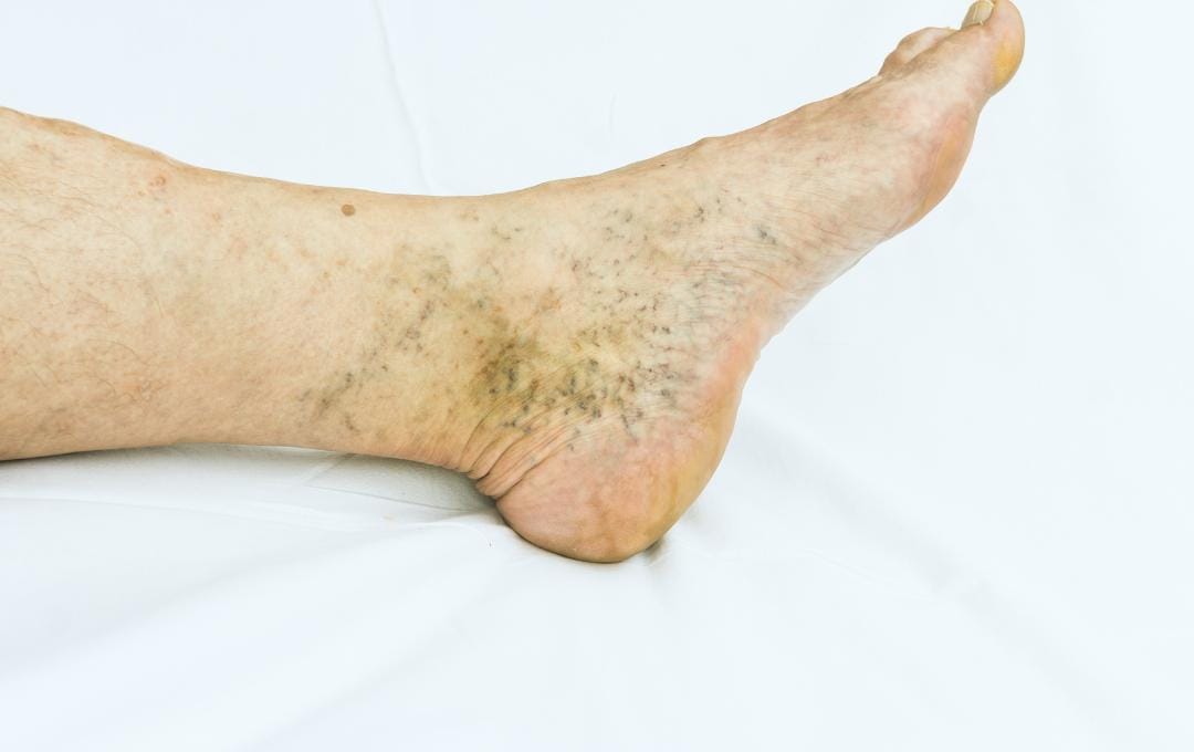 Understanding Brown Skin Discoloration On The Lower Legs 5 Brown discoloration on a patient's ankles and heels, which may look like tan, rust-colored, or reddish-brown.