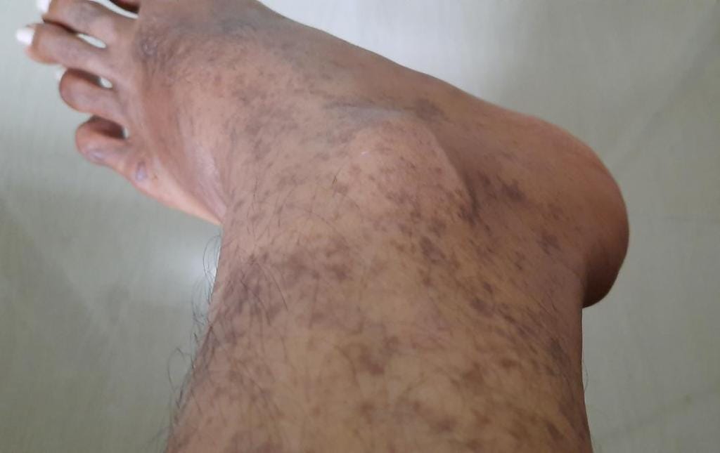 Understanding Brown Skin Discoloration On The Lower Legs 4 Brown, discolored spots appearing on a patient's ankles, which may indicate vein disease.